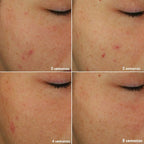 Set Novage+ Antimperfecciones Piel Normal A Grasa Oriflame