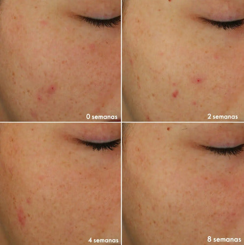 Set Novage+ Antimperfecciones Piel Normal A Grasa Oriflame